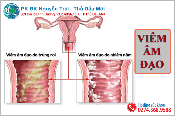 Những điều cần biết về viêm nhiễm âm đạo