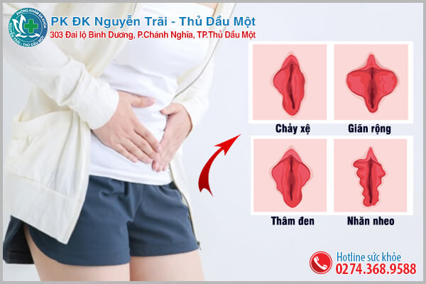 Trường hợp nào nữ giới cần đi cắt môi bé, môi lớn?