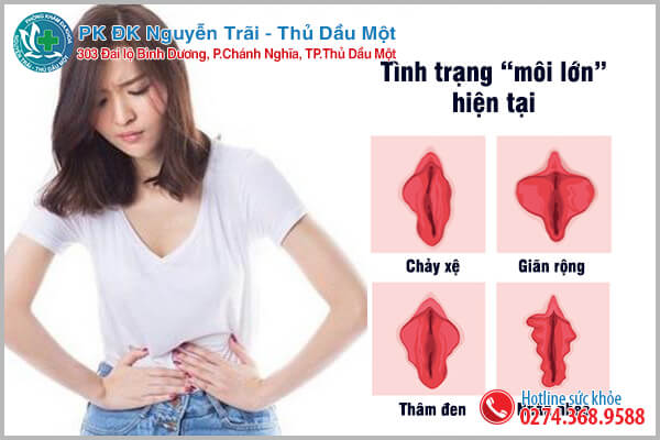 Khi nào nữ giới cần đi cắt môi lớn?