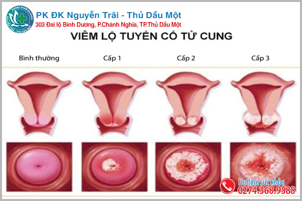 Viêm lộ tuyến cổ tử cung