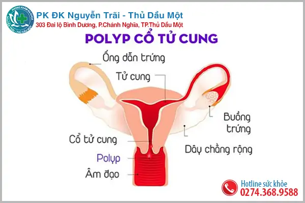 Phụ nữ bị polyp cổ tử cung có nguy hiểm không?