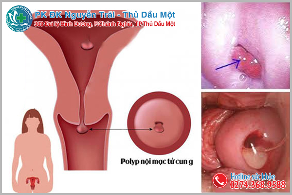 polyp cổ tử cung