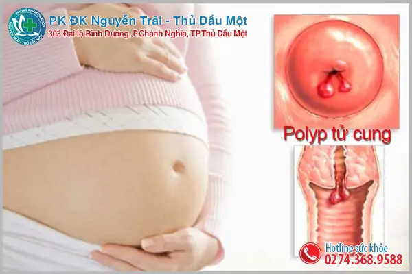 Những điều đáng chú ý về polyp cổ tử cung khi mang thai