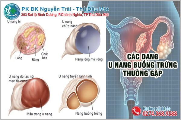 Các dạng u nang buồng trứng nữ giới cẩn phải lưu ý