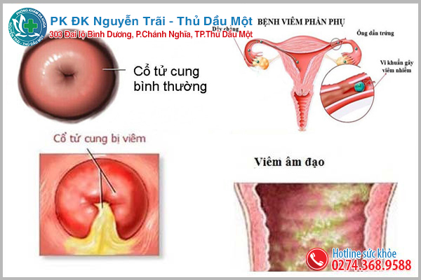 Khí hư có màu trắng đục là biểu hiện của bệnh lý gì?